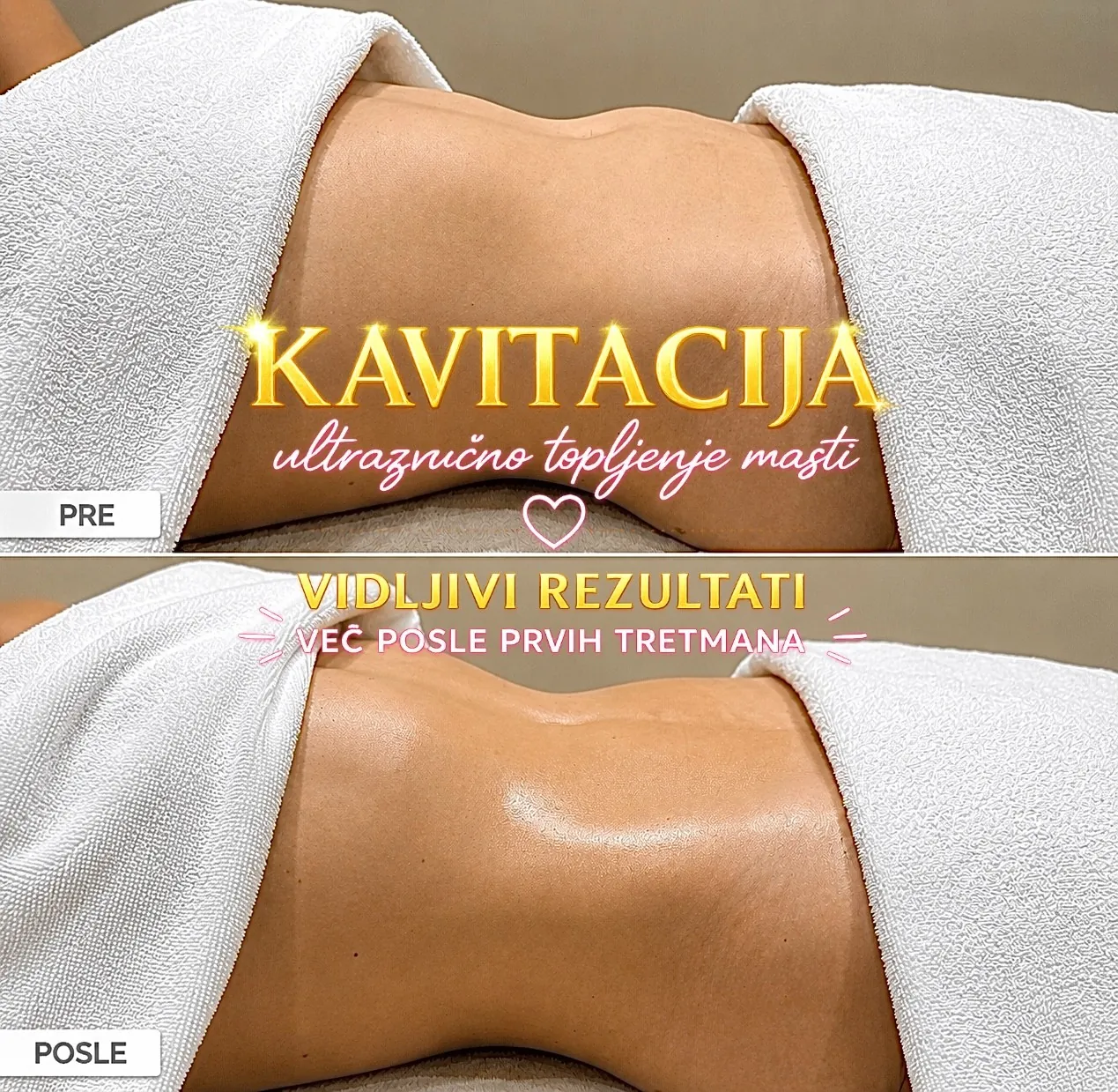Ultrazvučna kavitacija pre i posle tretmana